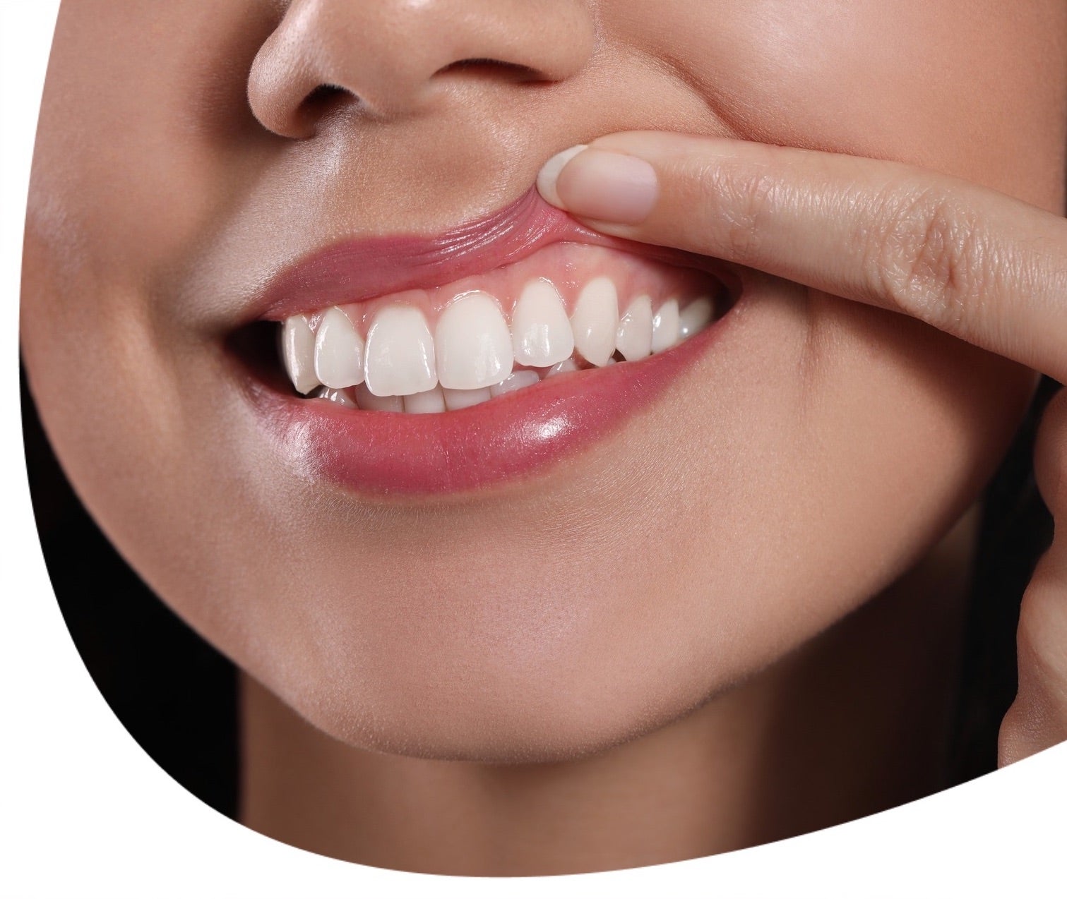 Fogínygyulladás: okok és következmények. Így előzd meg az ínybetegséget!